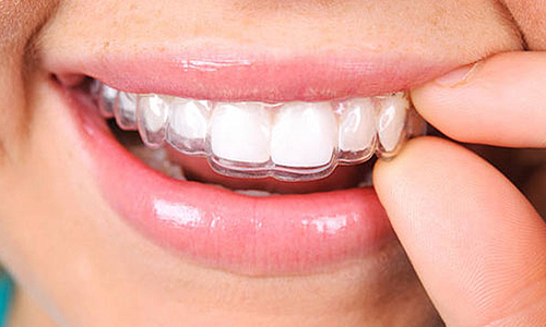 Invisalign in Charlotte NC.